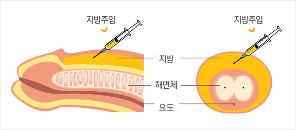 Áö¹æ¼¼Æ÷ ÁÖÀÔ¼ú / ÇÊ·¯Á¦À縦 ÀÌ¿ëÇÑ È®´ë¼ú