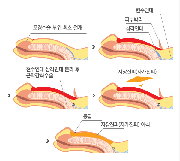 근막강화술
